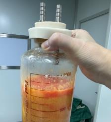 衢州水动力吸脂手术要做多久？